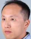 Before Hair Transplant&nbsp;Front